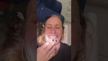 Bottom braces journey #adultorthodontics @BocaRatonTV
