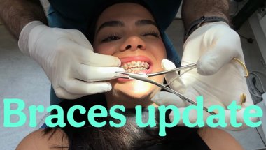 Braces update vlog #7 🦷 WHAT CHANGED?