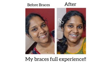 Teeth Braces experience /first time /subscribe, like👍