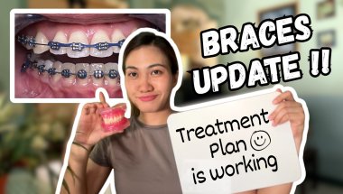 My Teeth Are More Complex Than Expected | Braces Update