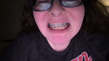 Start of Orthodontic Treatment (Plus Surprise)