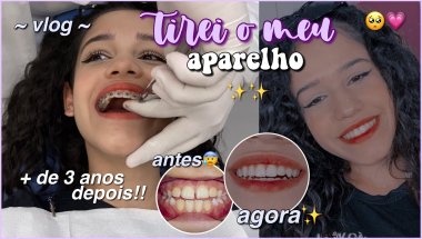 TIREI O APARELHO!! + de 3 anos depois🥺 ~vlog~