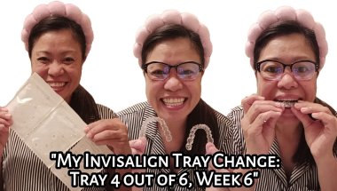 My Invisalign Tray Change: Tray 4 out of 6 | Week 6 | Experience | Tagalog