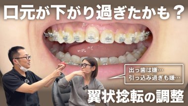 【口元下がりすぎ？】矯正開始から約1年3ヶ月。下がりすぎないように調整します【翼状捻転】