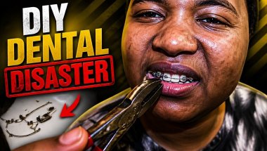 DIY Braces Removal: A Dentist's Worst Nightmare!