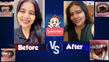 Everything about braces/price/timeline/pain/#trending #viral #youtube #trending #shortvideo