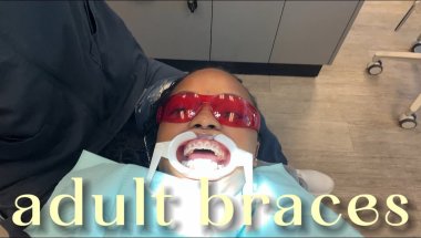 why I’m getting braces at 27….