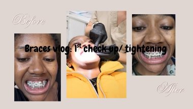 Braces vlog: 1st check up/ tightening