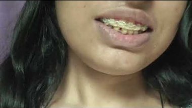 My braces condition of 11 months(). So sad for this😭😖#braces #love #sad #bracestransformation#dental