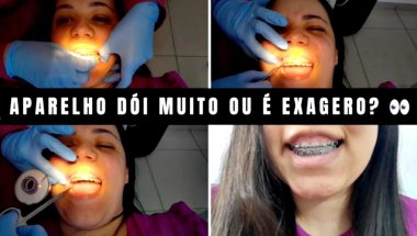 MITO OU VERDADE? 🤔 A cor do aparelho interfere em alguma coisa? 😱🦷