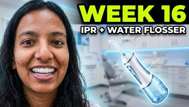 Part - 6 | Invisalign | Week - 16 | Interproximal Reduction (IPR) and New routine (Water Flosser)