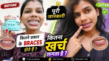 Wao मैने सोचा नहीं था braces treatment से मेरी life ही change  हो गई ✨🦷😍| full information braces
