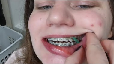 Braces Journey update 5/26/26. Started bands!