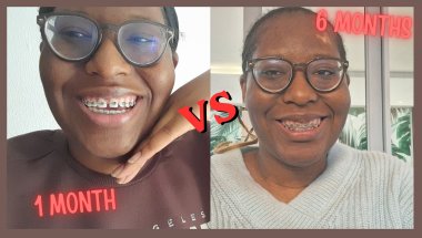 🦷 6 Months in Braces + 10 Things I Wish I Knew Before Getting Them