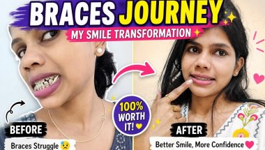 My braces journey✨🦷| before vs after transformation✨