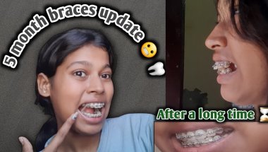 5 month braces update 😬 ||After a long time ⌛️ #dentaltreatment #dentist #dentalbraces #braces