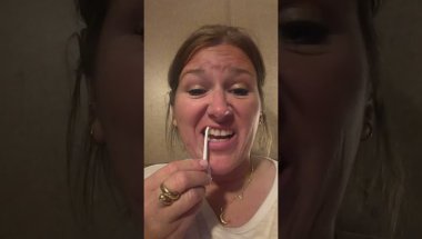Marpe update.   Tray 2 Invisalign simultaneously with the MARPE