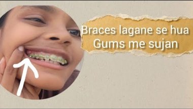 Braces lagane se hua gums me sujan |  braces lagana pada pahenga |