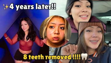 I HAD 4 TEETH EXTRACTIONS..WAS IT WORTH IT 4 YEARS LATER!? BRACES JOURNEY