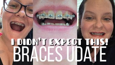 My Adult Braces Journey Just Took a Major Turn!