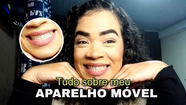 APARELHO ORTODÔNTICO MÓVEL - tudo sobre minha experiência 😁