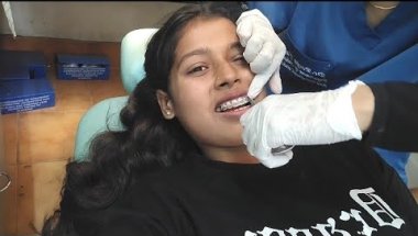 6 month braces tightening update 😬🦷#dental #bracestightening #dentalbraces #teethbraces