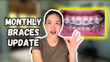 I REUSED my TADs to save money | Monthly Braces Update