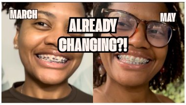 Adult Braces Update: Tightening, Color Change & Dental Cleaning 🩵🦋❄️