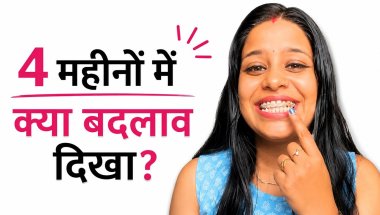 ✨ 4 Months with Braces | Amazing Teeth Changes & My Honest Experience.