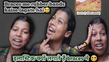 Braces me rubber bands (ilastic)🤐 kaise lagate hain🦷😬#dentalbraces #dentaltreatment #braces #dentist