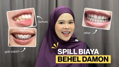 PASANG BEHEL SELF-LIGATING (DAMON), HABIS BERAPA YA?